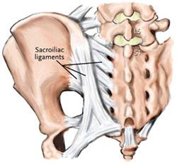 Sacroiliitis 