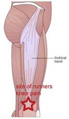 Trochanteric bursa steroid injection