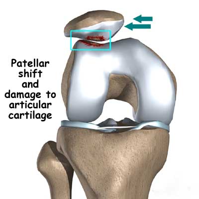 knee_chondromalacia_PS