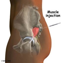 Corticosteroid injection for low back pain