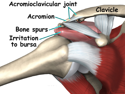 shoulder_impingement_PS